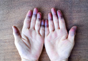 Bluish discoloration of fingers