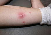 Deep skin abscesses