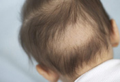 Unexplained Hair loss
