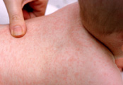 Skin Rash