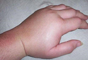 Swelling of hands
