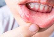 Oral or genital Ulcers